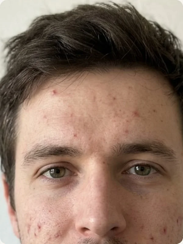 AI Blemish Remover: Upload Your Portrait